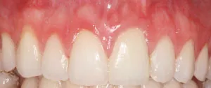 Patient's mouth after crown lengthening and restorative dentistry