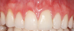 Patient's mouth after crown lengthening and restorative dentistry
