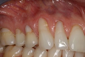 Patient's mouth before gum grafting