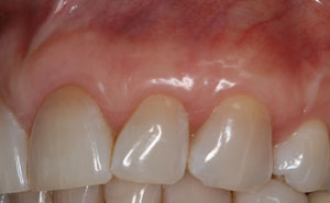 Patient's mouth after gum grafting