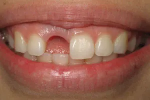 Patient's mouth with the infected tooth removed
