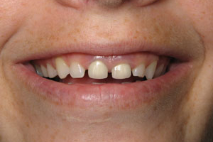 Patient's mouth before crown lengthening and restorative dentistry