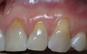 Patient's mouth before gum grafting