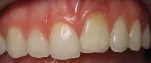 Patient's mouth before crown lengthening and restorative dentistry