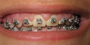 Patient's mouth with excess gum