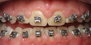 Patient's mouth with excess gum