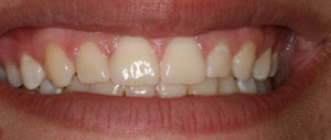 Patient's mouth after crown lengthening