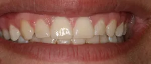 Patient's mouth after crown lengthening