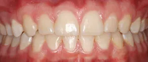 Patient's mouth after crown lengthening