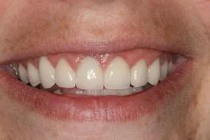 Patient's mouth after crown lengthening and restorative dentistry