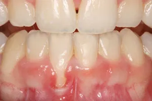 Patient's mouth before gum grafting