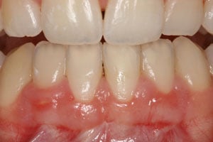 Patient's mouth after gum grafting