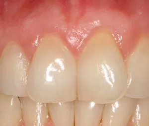Patient's mouth before gum grafting