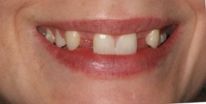 Patient's mouth with congenitally missing teeth