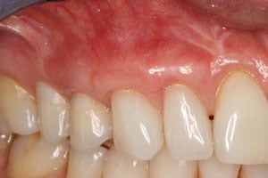 Patient's mouth after gum grafting