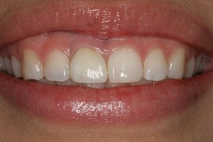 Patient's mouth with an infected tooth replaced by a dental implant