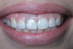 Patient's mouth with an infected tooth that needs replacement