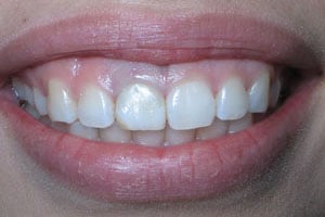 Patient's mouth with an infected tooth that needs replacement