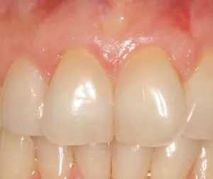 Patients teeth before gum grafting