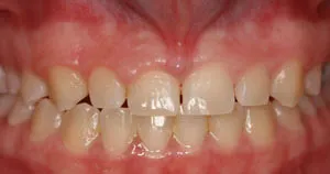 patient teeth with loose gum between front teeth