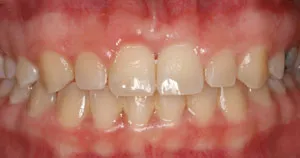 patient after loose gum corrected with frenectomy