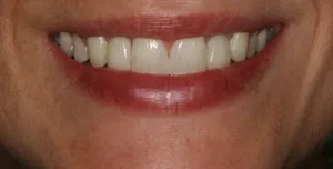 Patient smile after missing teeth replaced with dental implants