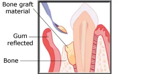 Diagram showing bone graft material being placed