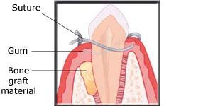 Diagram showing the gum sutured after bone grafting