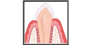 Diagram showing bone regeneration after bone grafting