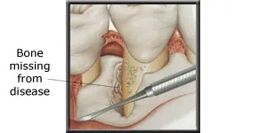 Diagram showing bone missing due to periodontal disease