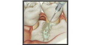 Diagram showing cell stimulating material being applied to the affected area