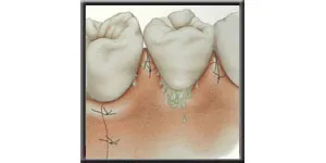 Diagram showing the gum sutured