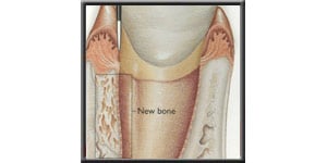 Diagram showing newly regenerated bone