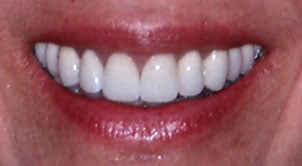 Patient's mouth after crown lengthening and restorative dentistry