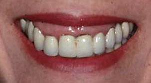 Patient's mouth before crown lengthening and restorative dentistry