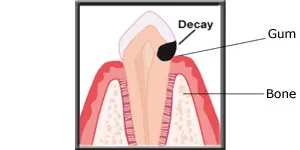 Diagram showing a tooth with decay under the gumline