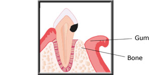 Diagram showing the gum being reflected to access the decay