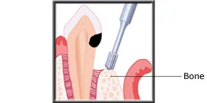 Diagram showing bone being removed to access the decay