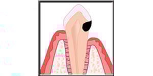 Diagram showing the gum replaced and the decay now visible