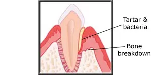 Diagram showing periodontal breakdown of bone