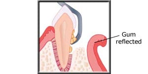 Diagram showing the gum being opened and bacteria being cleaned out