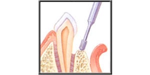 Diagram showing bone reshaping