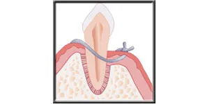 Diagram showing the gum sutured close to the bone