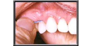 up close image of front teeth being flossed