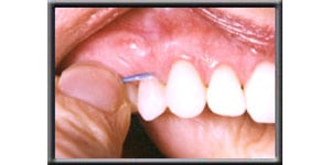 up close image of front teeth being flossed