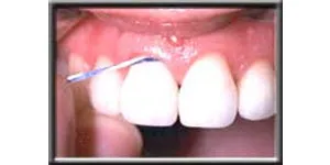 up close image of front teeth being flossed