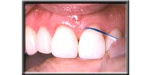 up close image of front teeth being flossed