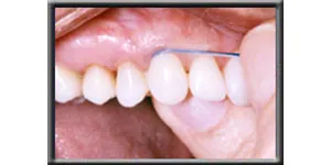 up close image of front teeth being flossed