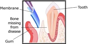 Diagram showing a membrane being placed to isolate the missing bone area