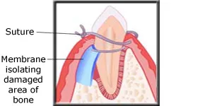 Diagram showing the gum sutured